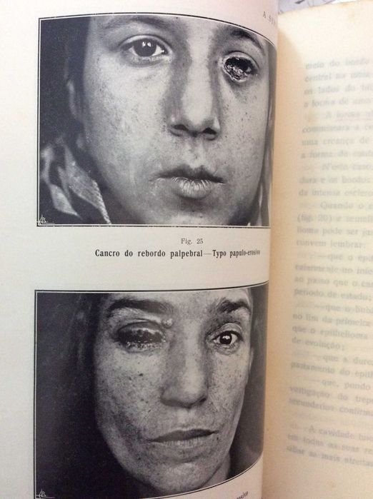 A Syphilis - Suas manifestações tegumentares. Imagens impressionantes.