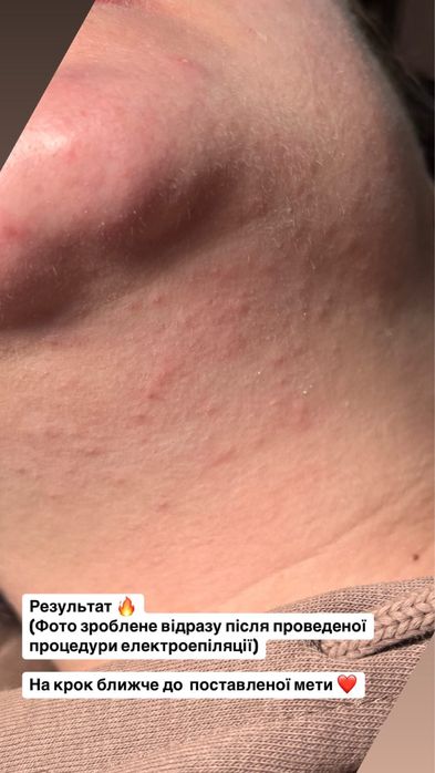 Електроепіляція / Електроепиляция