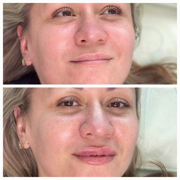 Збільшення губ КП губ Ботокс Дніпро