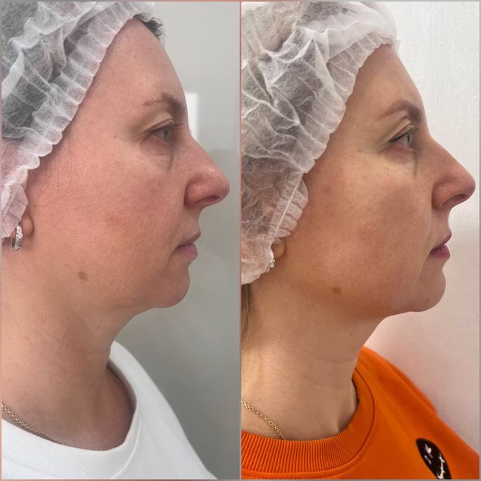 Похудение,ботокс,губы,рф,смасс,косметолог