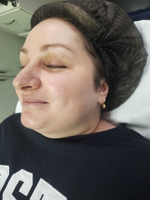 Косметолог Лівобережна чистка, карбоксі, пілінг, фракційна мезотерапія