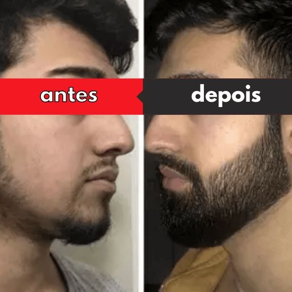 Minoxidil foligain extra forte + dermaroller