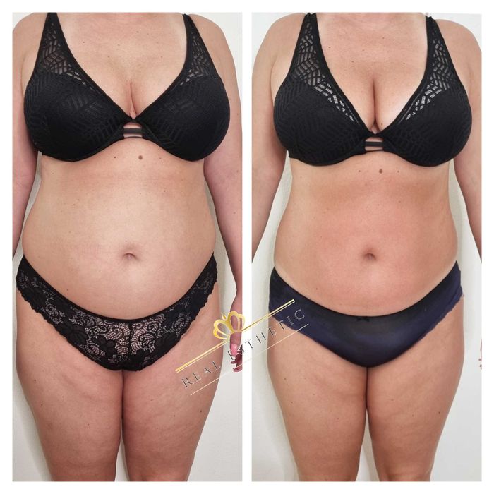 Emesculpt/Embody/ BTL