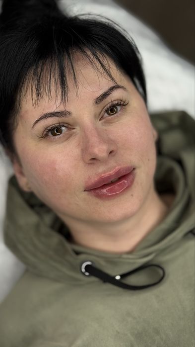 Збільшення губ, ботулінотерапія!