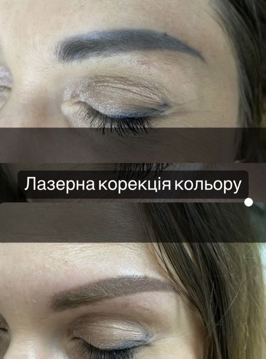 Видалення татуажа тату перманента лазером бровей стрелок губ ремувер