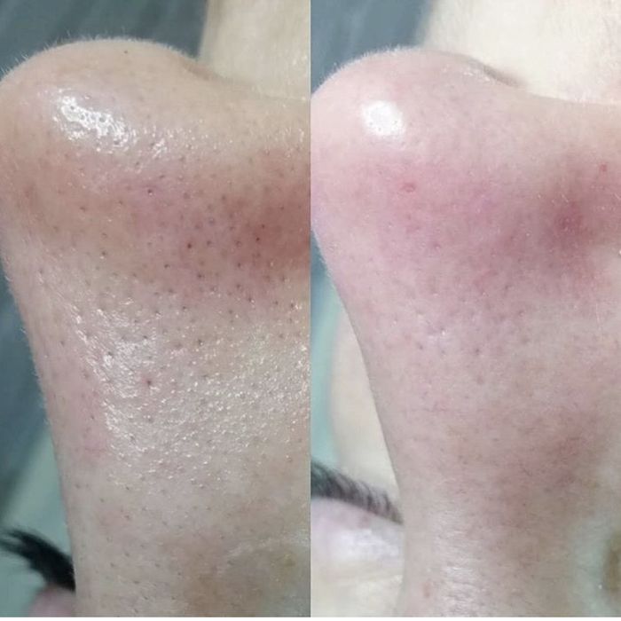 Чистка обличчя, УЗ чистка, механічна. Пілінг. Електропорація