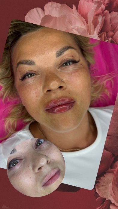 Увеличения Губ Контурная пластика,ботокс