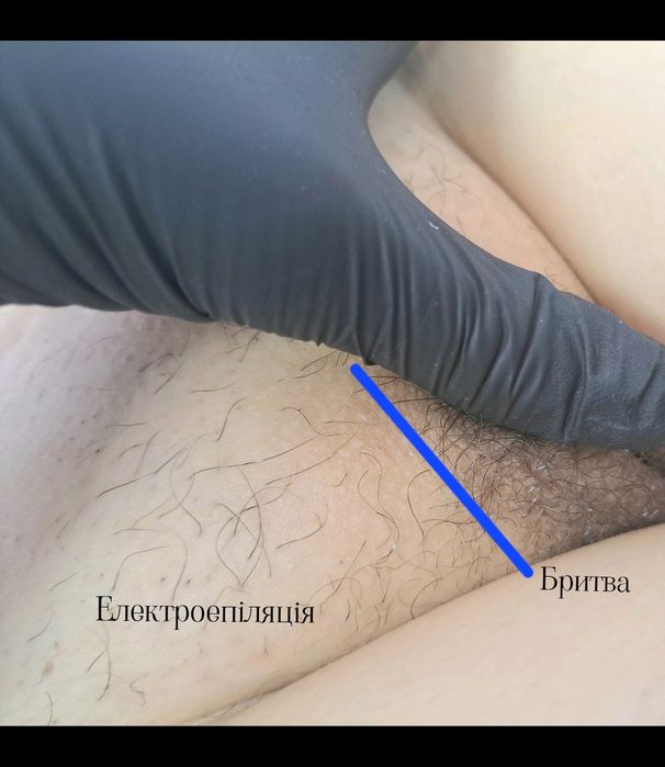 Електроепіляція, центр міста