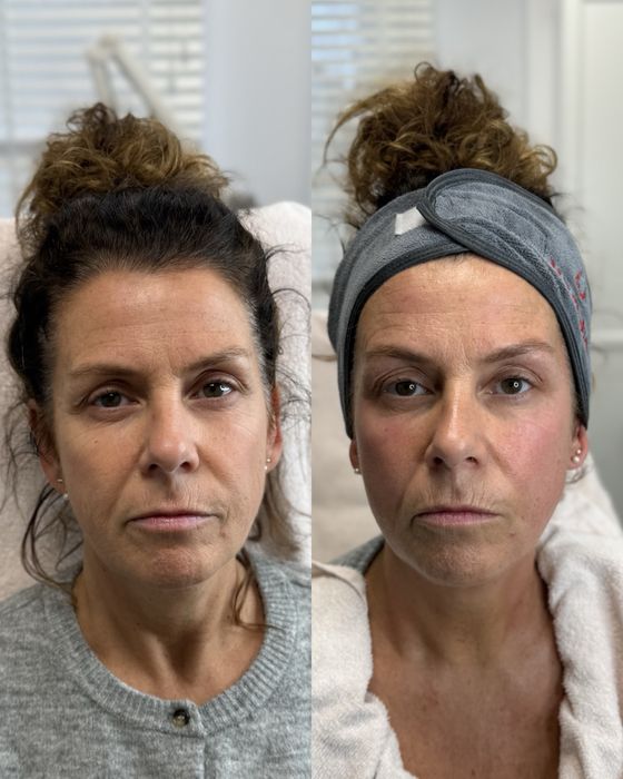 Міофасціальний масаж обличчя