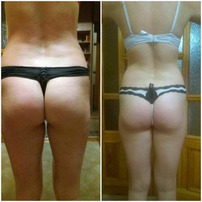 Вакумний антицелюлітний масаж