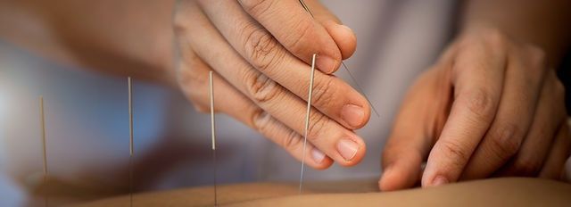 Akupunktura Zdrowotna - Suche Igłowanie / 100zł sesja akupunktury