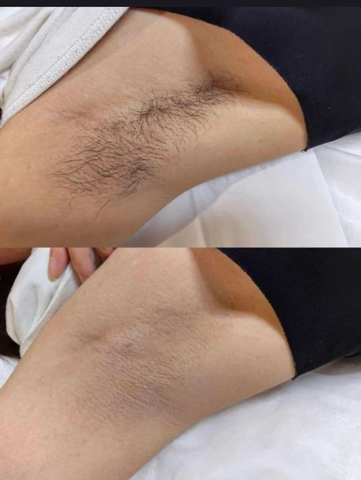 Depilação a Laser Profissional Fundão