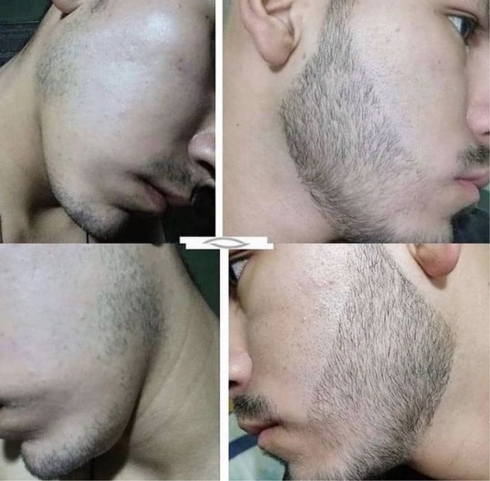 Minoxidil kirkland caixa selada + dermaroler