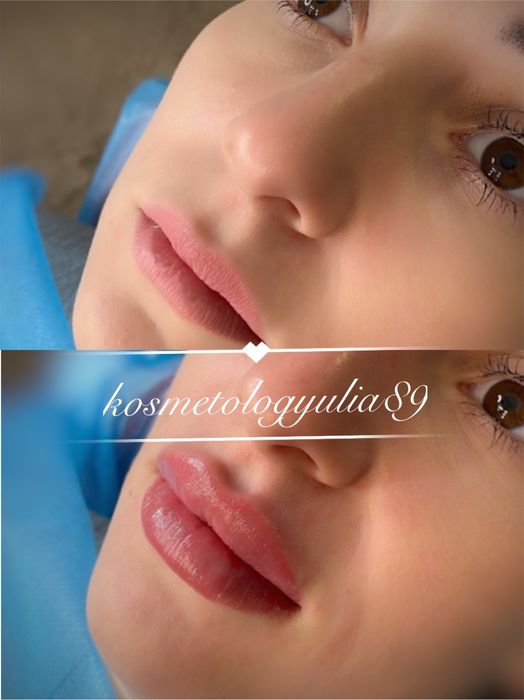 Увеличение губ от 2300 грн Sardenya Deep