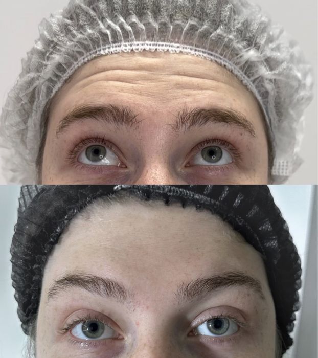 Ботулінотерапія по собівартості, модель ботокс від 500 грн АКЦІЯ