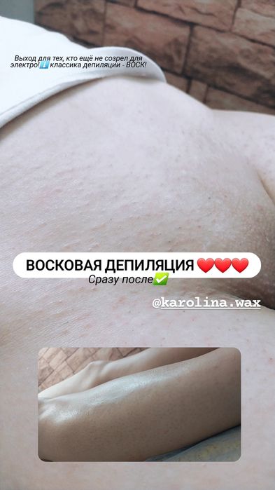 Електроепіляція та воскова депіляція. 10 років досвіду. Центр Бучі.