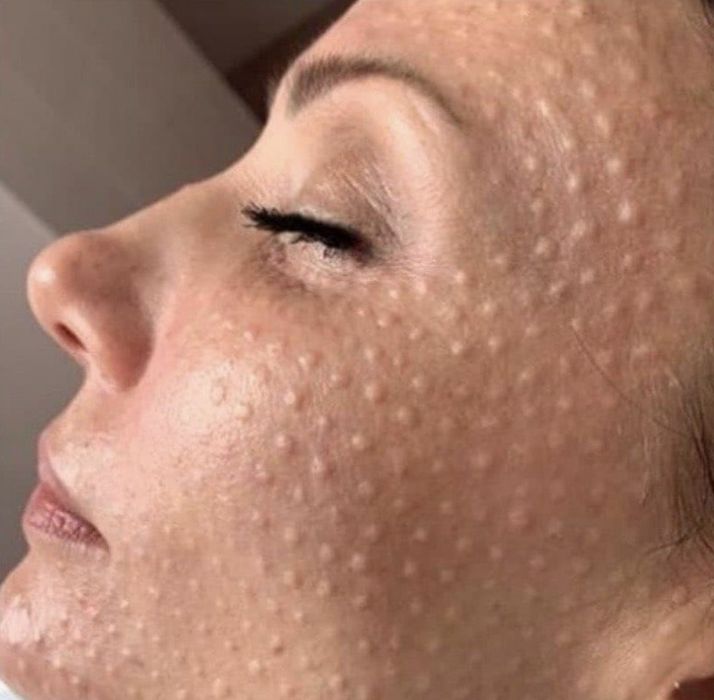 Плазмоліфтінг. Послуги косметолога.