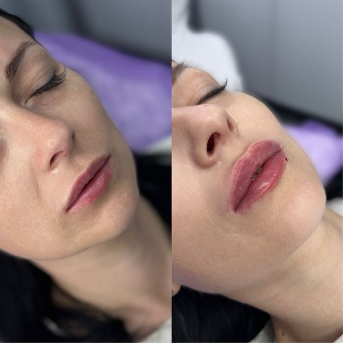 Косметолог|Ботокс|Контурна пластика губ.Центр міста