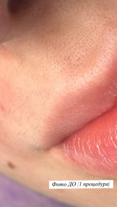 Електроепіляція / Електроепиляция