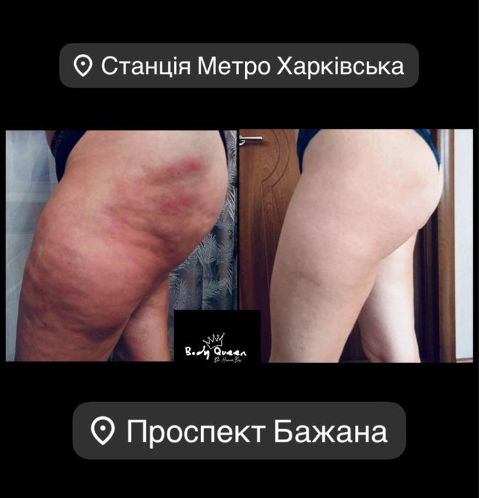 Ендосфера | Антицелюлітний масаж | Корекція фігури | Київ