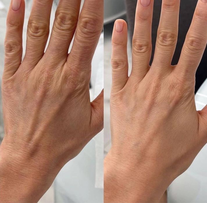 Послуги косметолога Львів чистка обличя біоревіталізація ботокс