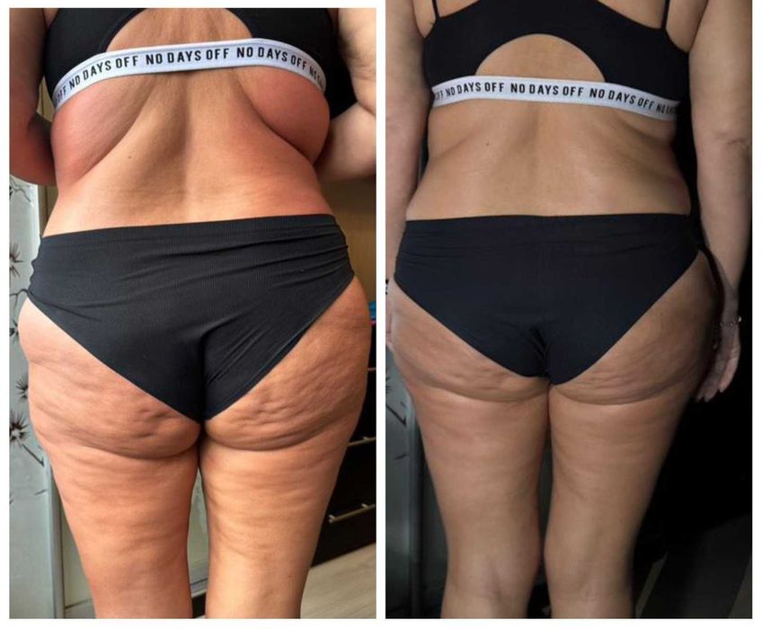 Лікувально оздоровчий масаж,антицелюлітний масаж Дарницький рн Позняки