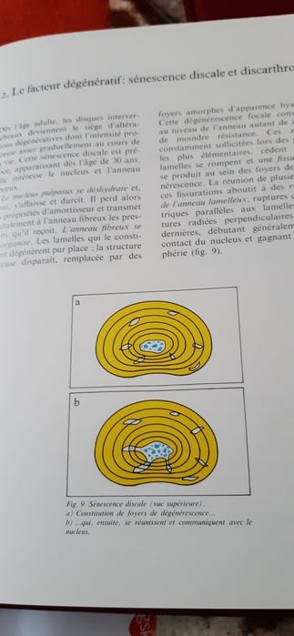 Przepuklina dyskową i artrozy kręgosłupa