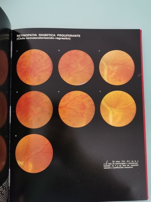 Atlas de Retinopatias vasculares