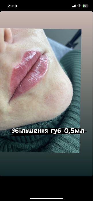 Збільшення губ троєщина 2000-1мл