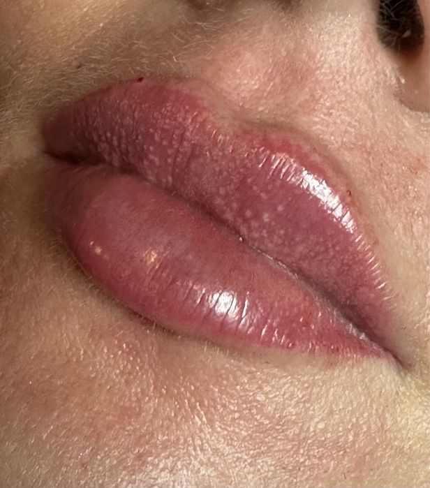 Usta na płasko, BTX, mezoterapia, lipoliza