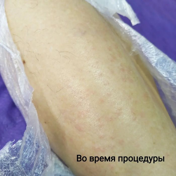 Электроэпиляция, центр города