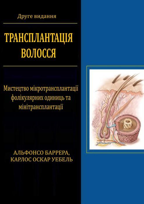 Трансплантація волосся АЛЬФОНСО БАРРЕРА 2014 р.