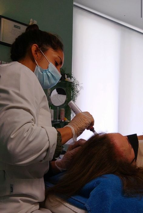 Tratamento Microneedling Capilar para queda do cabelo