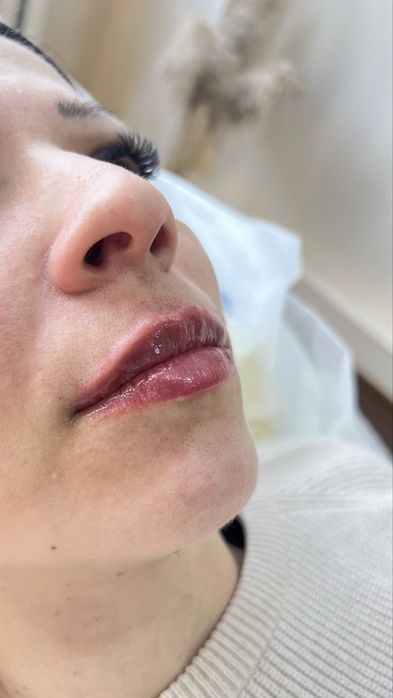 Увеличение губ , ботулинотерапия, контурная пластика