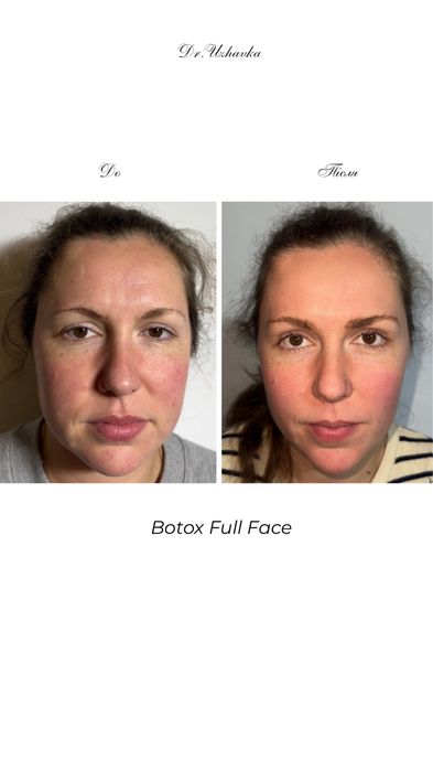 Ботокс чоло-1900 грн!Біоревіталізація, збільшення губ Одеса, центр