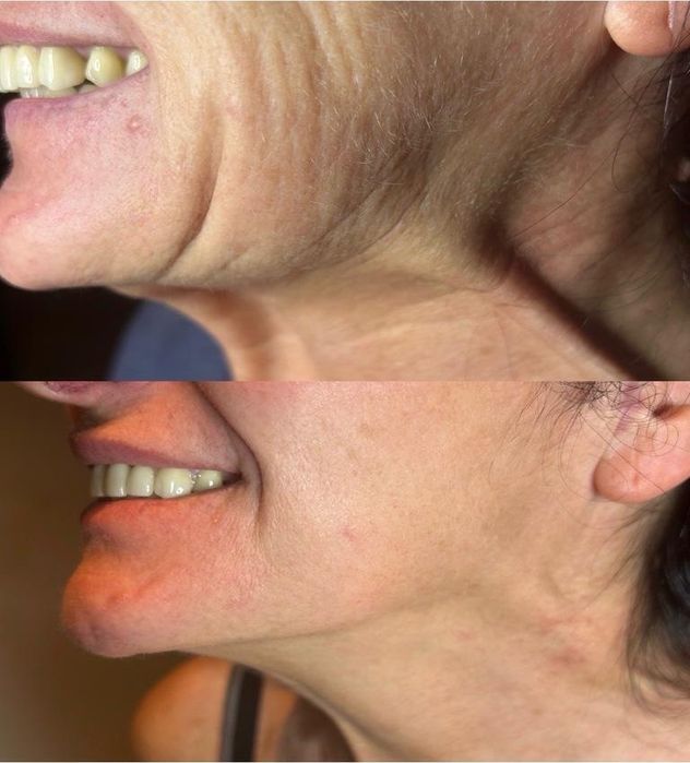 -50% BTX/ botoks/ botox/ powiększanie ust