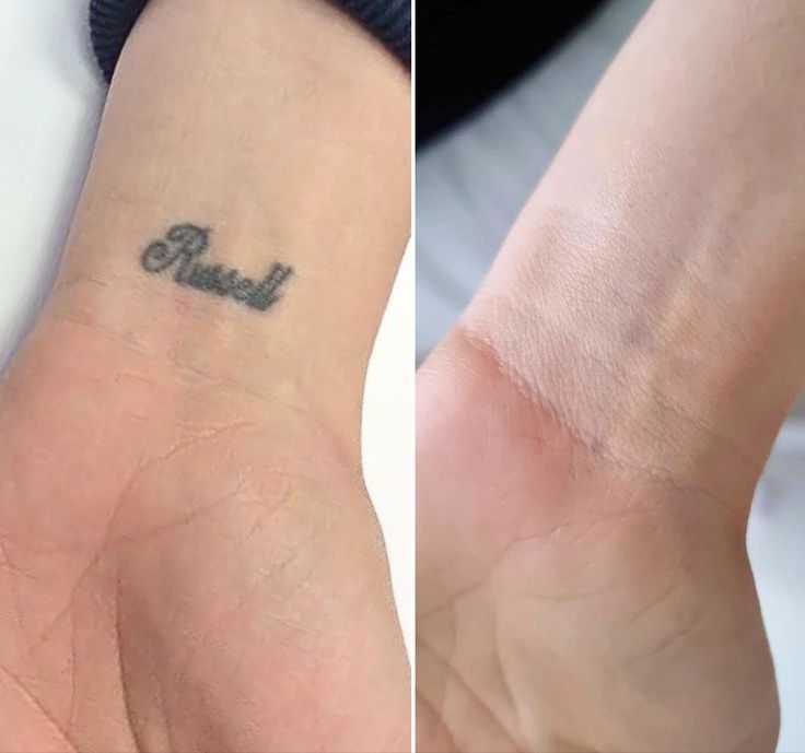 Професійний ,Діодний лазер пікосекундний   2в 1/ 808 1064 755nm