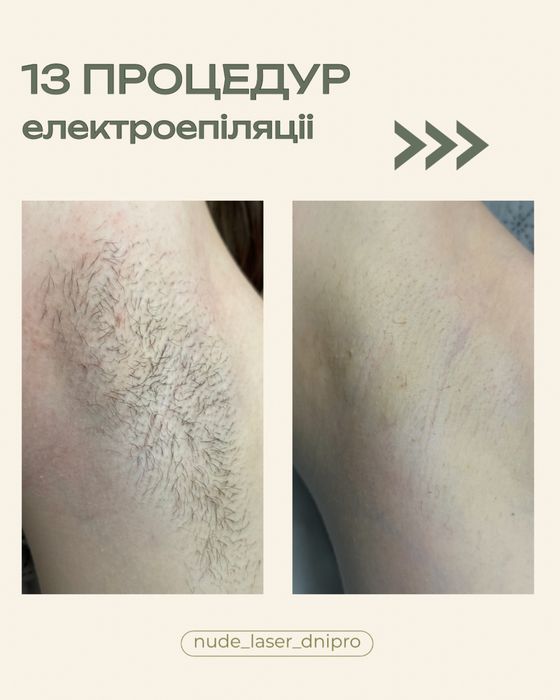 Професійна Лазерна епіляція, ЕЛЕКТРОепіляція ПОКРОВ