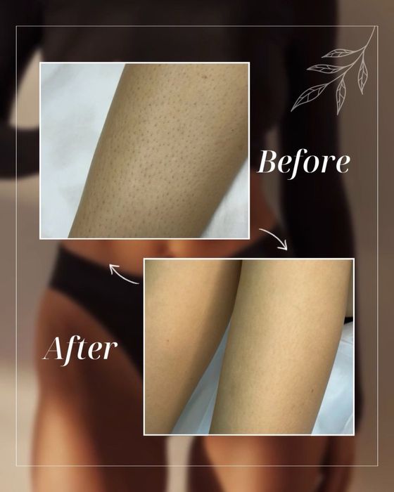 Лазерна епіляція в Запоріжжі — гладка шкіра надовго