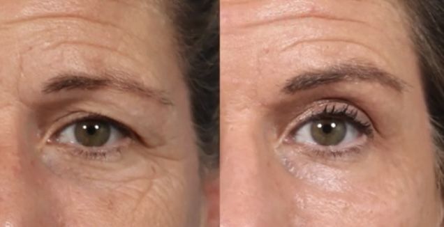Безоперационная Блефаропластика