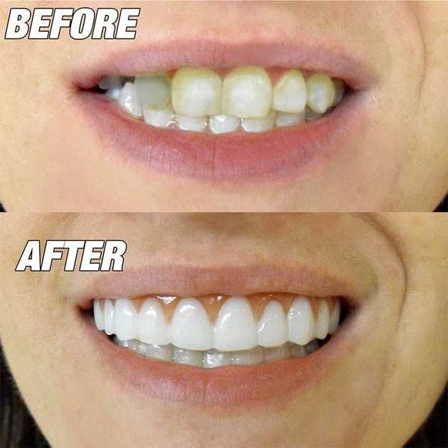 Виниры съемные для зубов верхней челюсти Perfect Smile Veneers