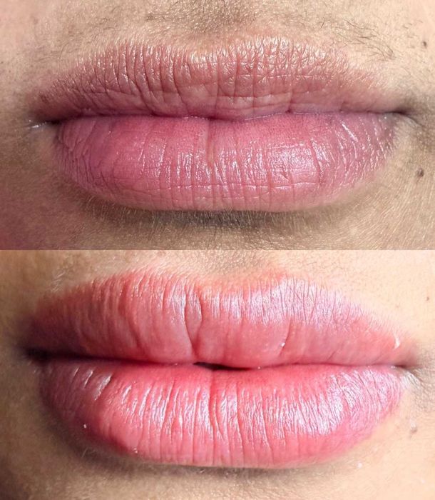 Micropigmentação Labial & Despigmentação Laser - Figueira da Foz