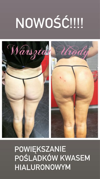 300zł= Kwas Hialuronowy Powiększenie Ust / Wolumetria 250z/ BOTOKS 200