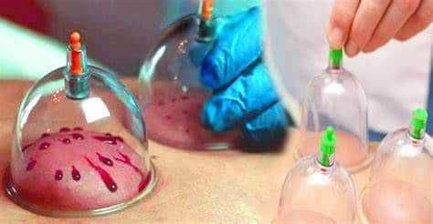 АРАБСЬКА ХІДЖАМА - вакуумна терапія