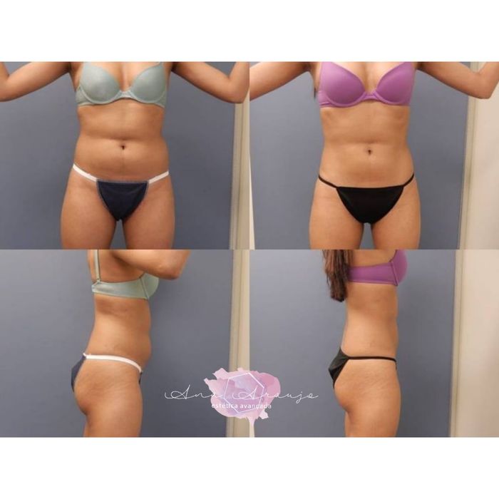 Criolipolise (tratamento para gordura)