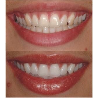 Branquemento dentario