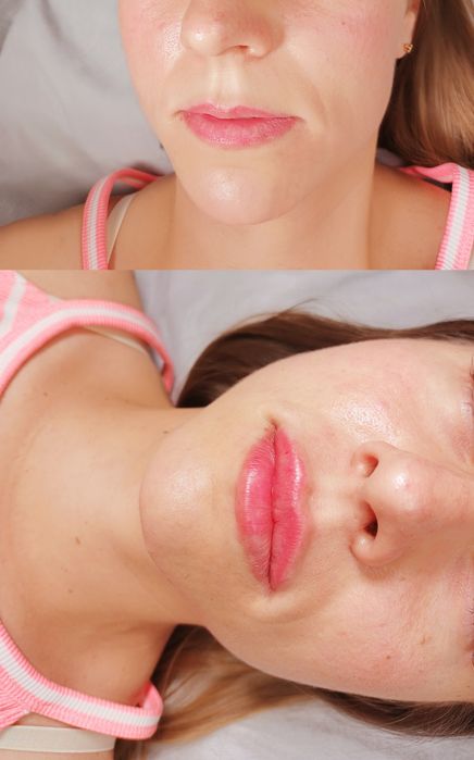 Косметолог. Контурна пластика губ, мезотерапія, біоре-ція, ліполітик.