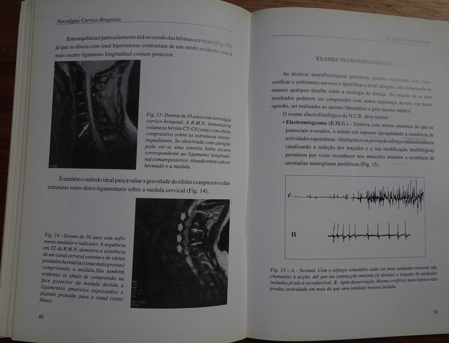 Nevralgias Cervico-Braquiais (Monografia) de Filipe Duarte e Rui Vaz