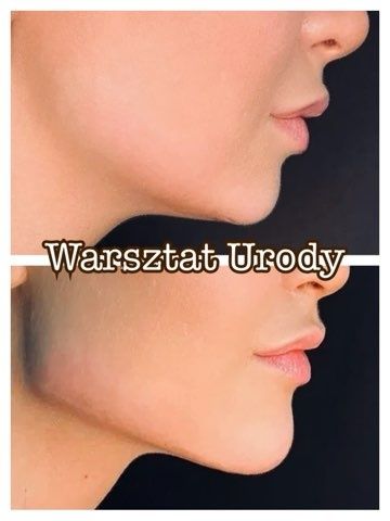 300zł= Kwas Hialuronowy Powiększenie Ust / Wolumetria 250z/ BOTOKS 200