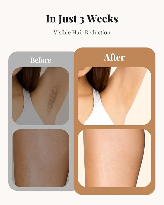 Dispositivo de remoção de cabelo a laser Haarlosy IPL para mulheres e